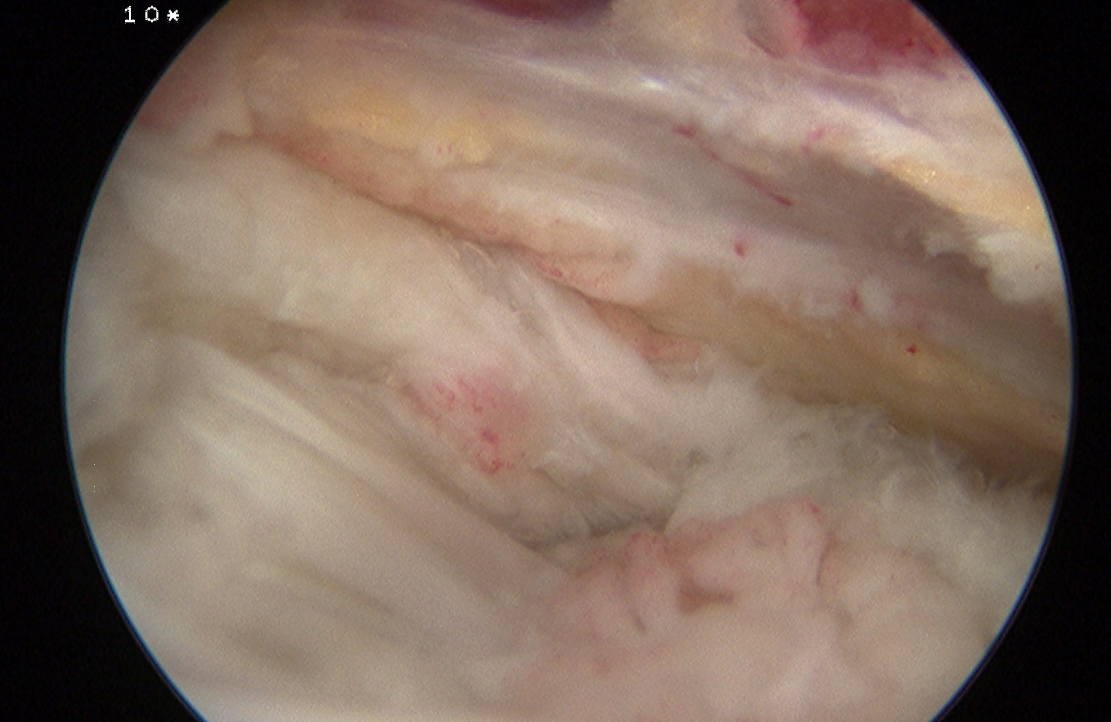 Shoulder Scope Bursal Supraspinatous Tear